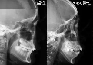 骨性齙牙與(yu) 牙性齙牙