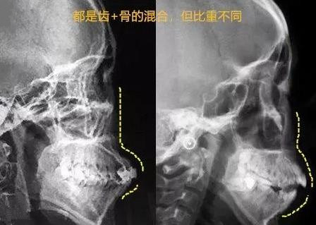 骨性和牙性結合的齙牙