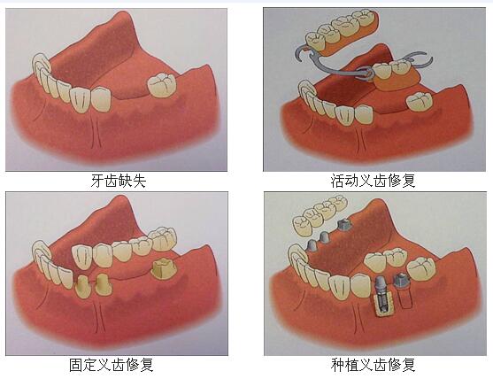 醫院裝一顆假牙多少錢