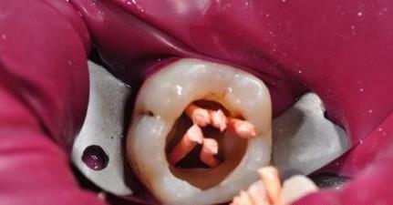 根管治療後的牙齒會(hui) 怎麽(me) 樣