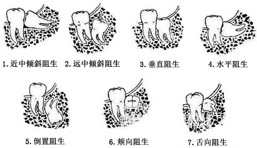 智齒的類型