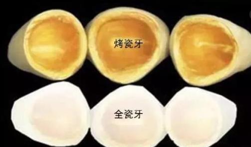 做一顆威蘭(lan) 德全瓷牙多少錢