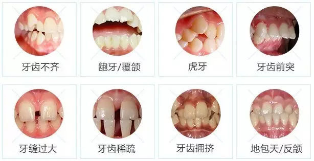 小孩子第二批牙齒不整齊怎麽(me) 辦