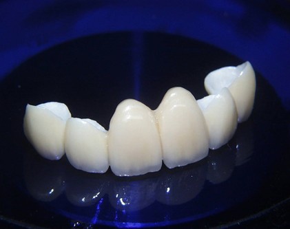 德國威蘭(lan) 德全瓷牙