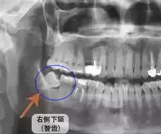 智齒需要拔的情況