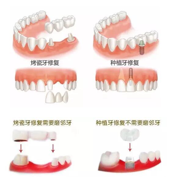 烤瓷牙換種植牙多少錢
