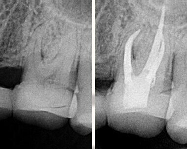 根管失敗後還能再治療嗎，成功率高嗎