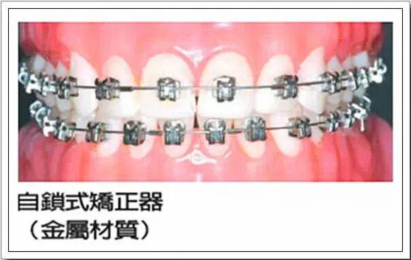 金屬自鎖牙套的原理和價(jia) 格