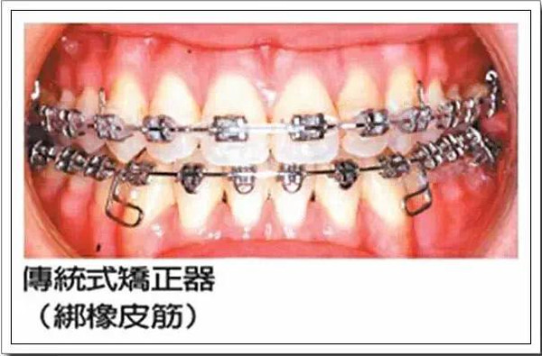 傳(chuan) 統金屬牙套