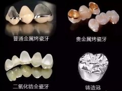 成年人多大做烤瓷牙比較好，有年齡限製嗎