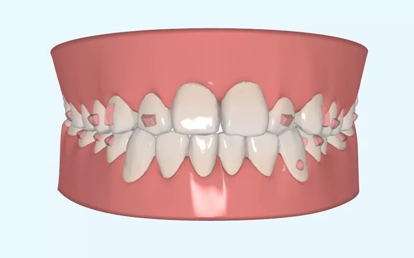 隱形牙套牙齒上麵那個(ge) 附件是做什麽(me) 的