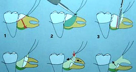 拔智齒是怎麽(me) 做的