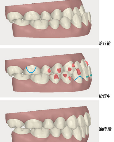 兒(er) 童牙齒矯正