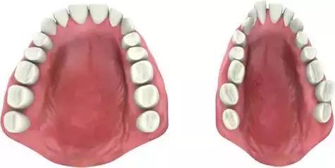 正常牙弓和擴弓後