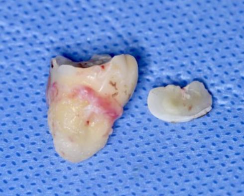 深圳愛康健口腔醫院哪些情況需要拔牙？