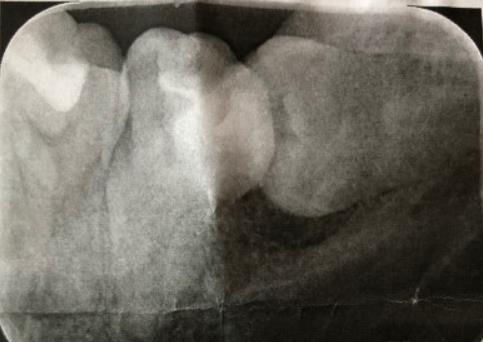 深圳拔牙真的不痛嗎