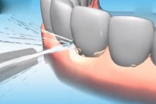 洗牙能社保卡報銷嗎