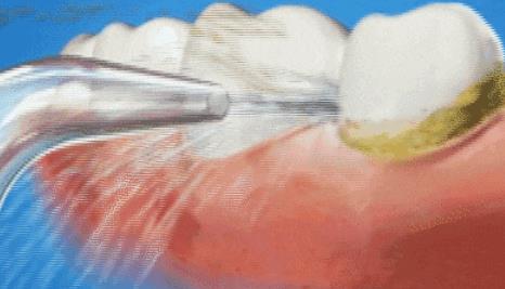 南山醫院洗牙費用