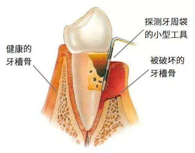 齦下刮治牙結石