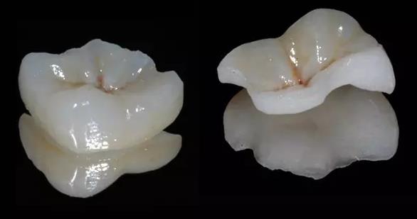 牙齒嵌體(ti) 補牙