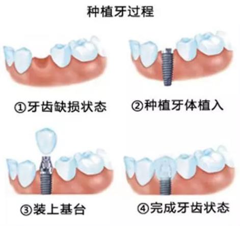 種牙是怎麽(me) 種的？