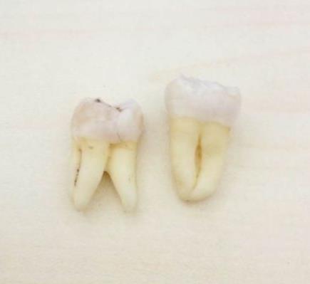 拔牙根價(jia) 格