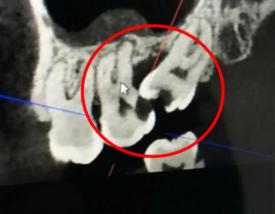 智齒要長出來了才能拔嗎