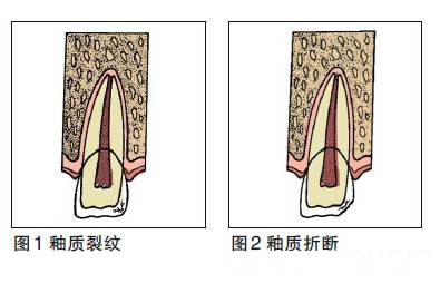 牙外傷(shang) 及早看牙醫