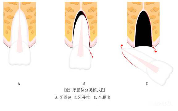 牙外傷(shang) 及早看牙醫
