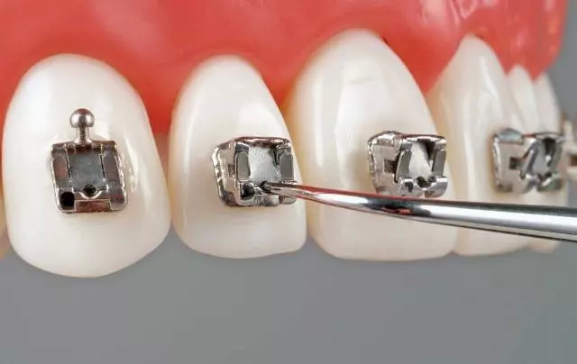 鋼絲(si) 牙套托槽