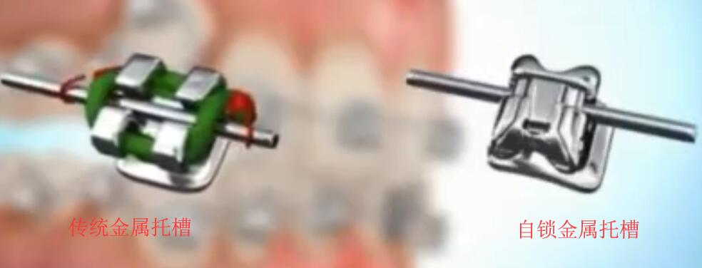 金屬牙套和自鎖牙套