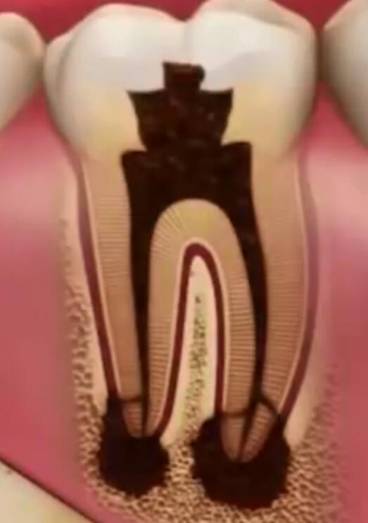 根管治療的目的是什麽(me) 