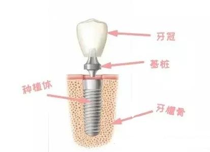 一顆完整種植牙的結構