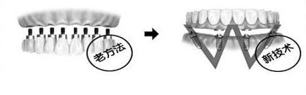 種植全口牙是怎麽(me) 做的