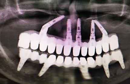 種植滿口牙的價(jia) 格