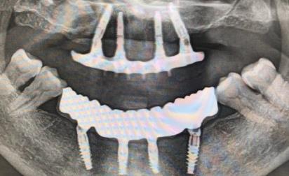 掉牙多年不修複的危害