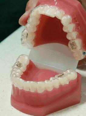隱形牙套