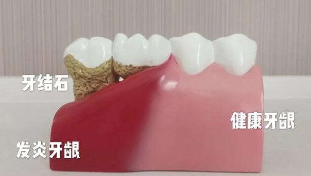 健康的牙齦