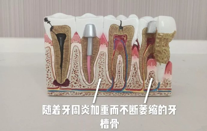 牙槽骨萎縮