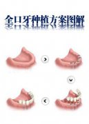 深圳種植牙價格表