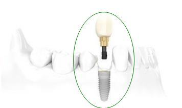 種植牙與(yu) 傳(chuan) 統假牙相比有哪些優(you) 勢?