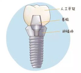 深圳種植牙後的護理問題