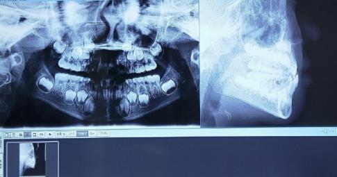 換牙期牙齒情況