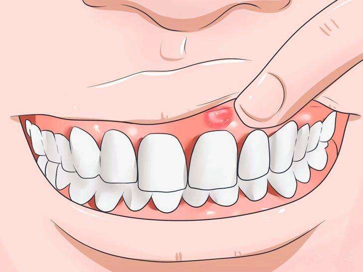 牙齦腫痛怎麽(me) 快速止痛