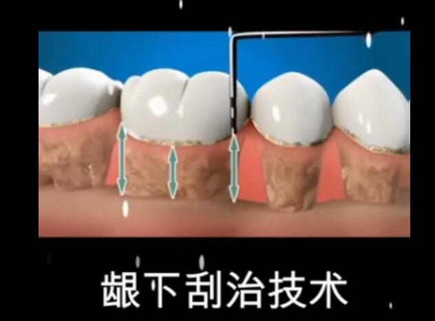 齦下刮治