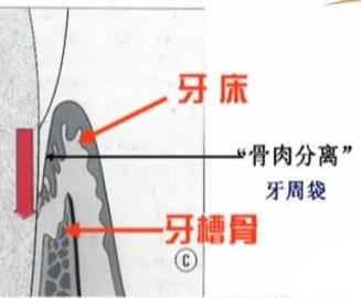 牙周炎的牙周袋