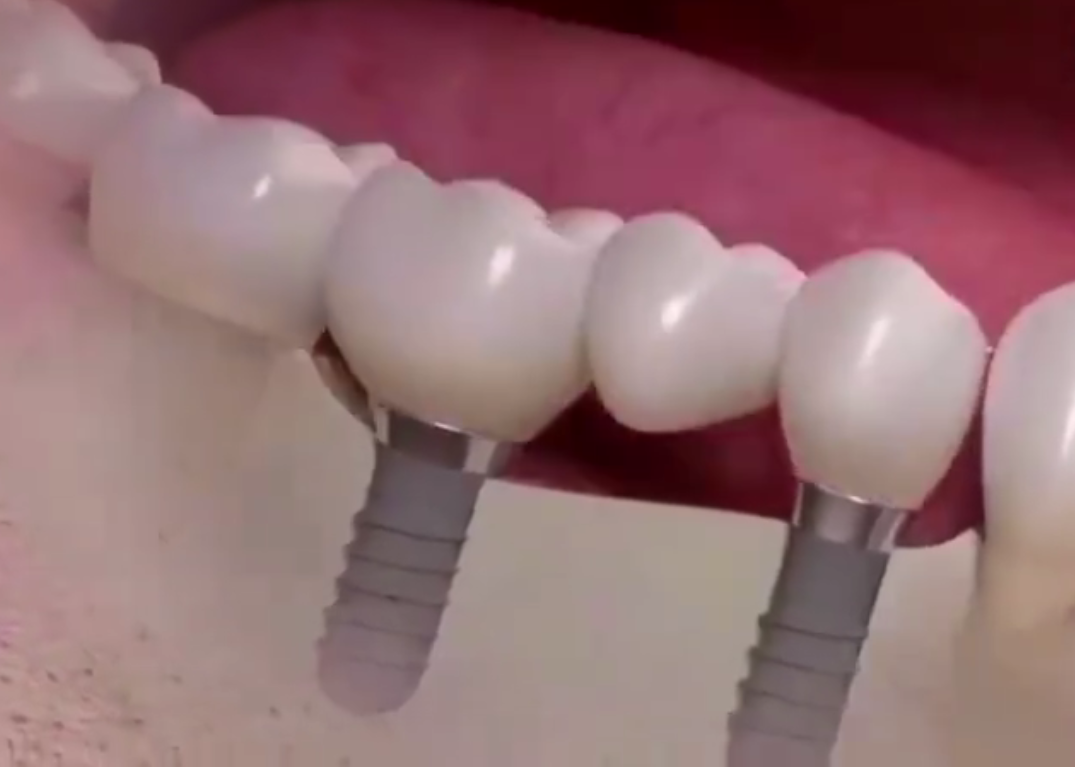 老年人做種植牙