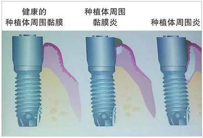 種植牙體(ti) 周圍炎