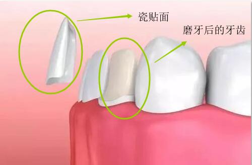 瓷貼麵磨牙後的樣子圖