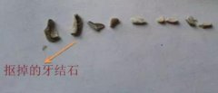 聽說牙結石可以自己動手去除?千萬別那樣做